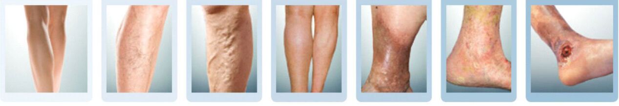 Stages of development of varicose veins of the legs