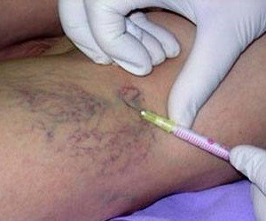 prick-by-varicose veins