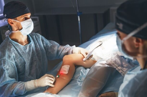 Surgery of varicose veins with a laser