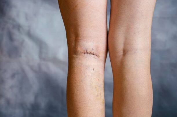 Suture on the leg after the operation for varicose veins