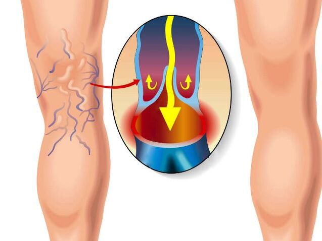 healthy leg and varicose veins in the leg