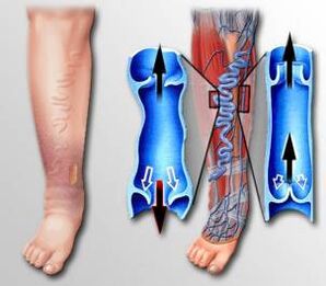 Blood circulation in the leg with varicose veins