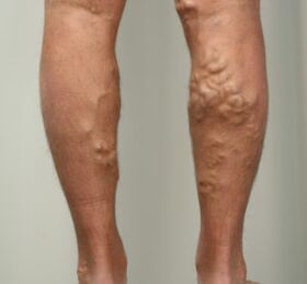 Lumps on the legs with varicose veins