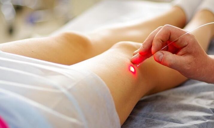 Laser treatment of varicose veins