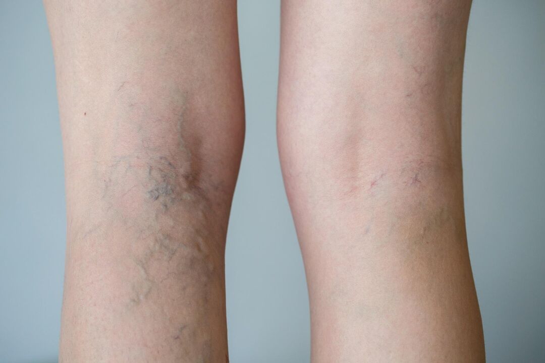 Varicose veins on the leg photo 2