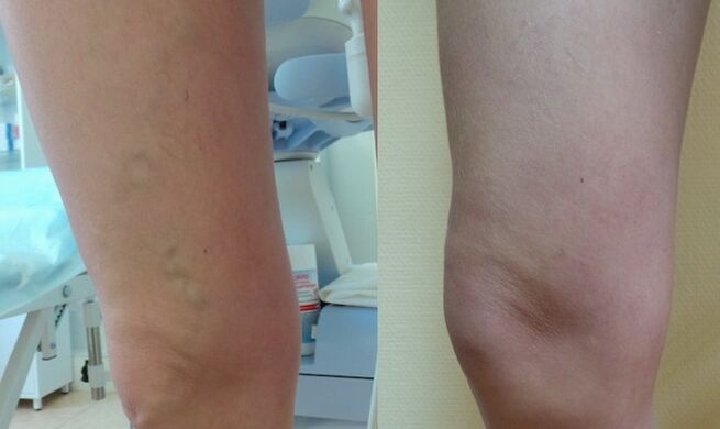 Leg before and after reticular varicose veins treatment