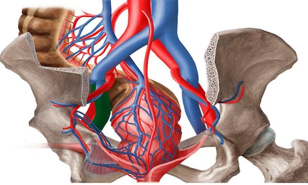 Varicose veins of the pelvis