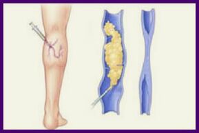 Sclerotherapy is a popular way to get rid of varicose veins on your legs