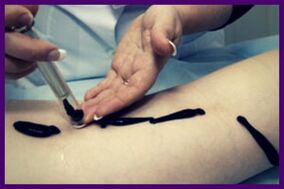 The procedure for treating varicose veins with leeches (hirutherapy)