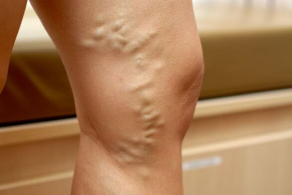 Varicose veins on the leg with varicose veins of the pelvis