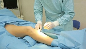 How is the operation performed on varicose veins