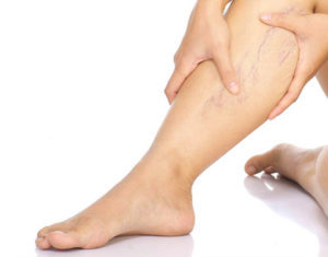 Pain with varicose veins