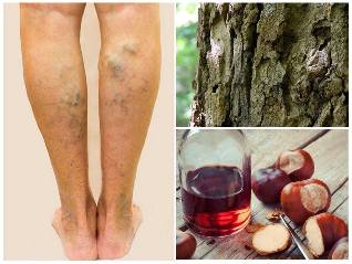 the treatment of varicose veins of the legs folk medicine