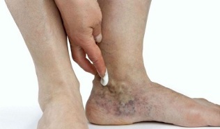 Manifestations of varicose veins on the legs