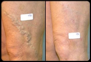 Before and after a vein operation