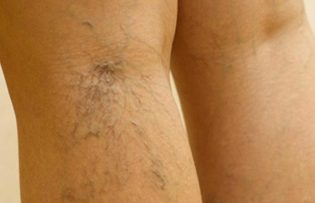 Treatment of varicose veins in the legs