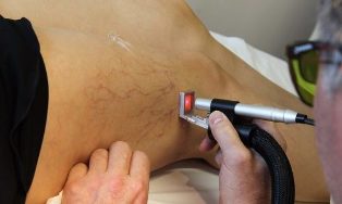 Treatment of varicose veins with Laser