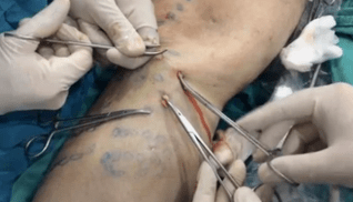 How is a phlebetomy performed to remove varicose veins