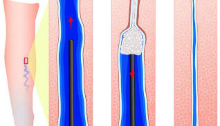 The introduction of sclerosant during sclerotherapy