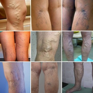 Photo of varicose veins of the lower extremities
